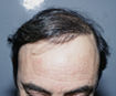 témoignage temoignage greffe cheveux implant chirurgie