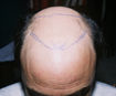 témoignage temoignage greffe cheveux implant chirurgie