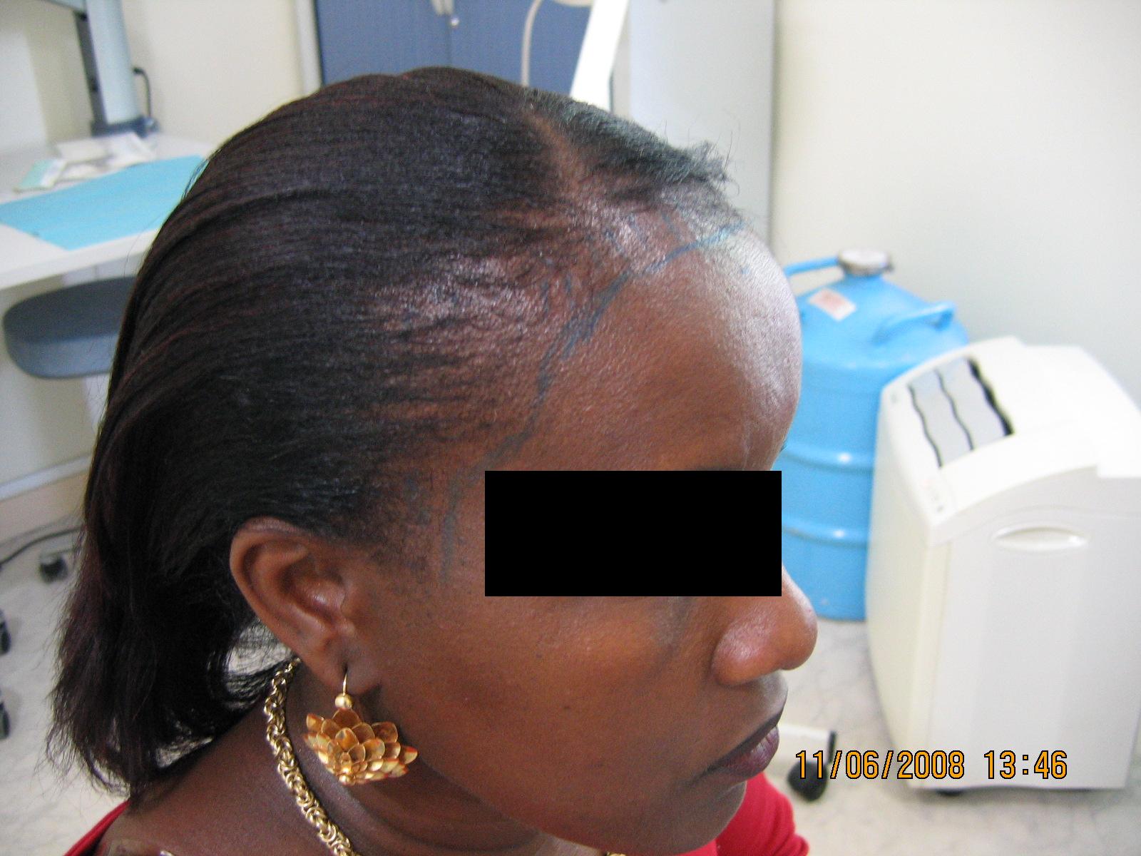 témoignage temoignage greffe cheveux implant chirurgie