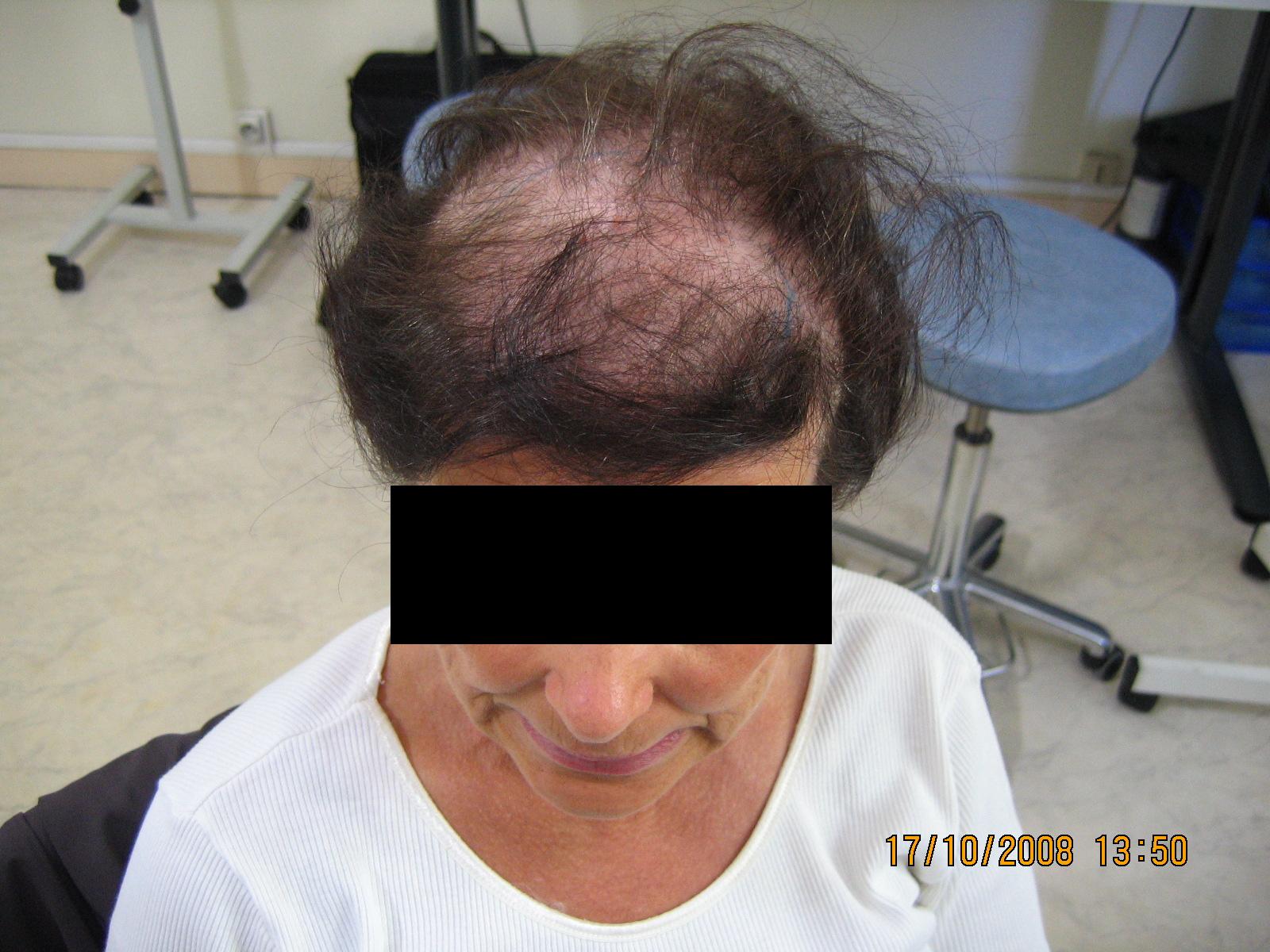 témoignage temoignage greffe cheveux implant chirurgie