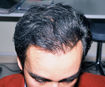 implantation cheveux